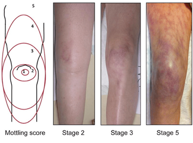 mottling score